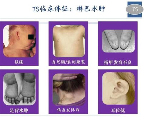 轉角病|特纳综合征